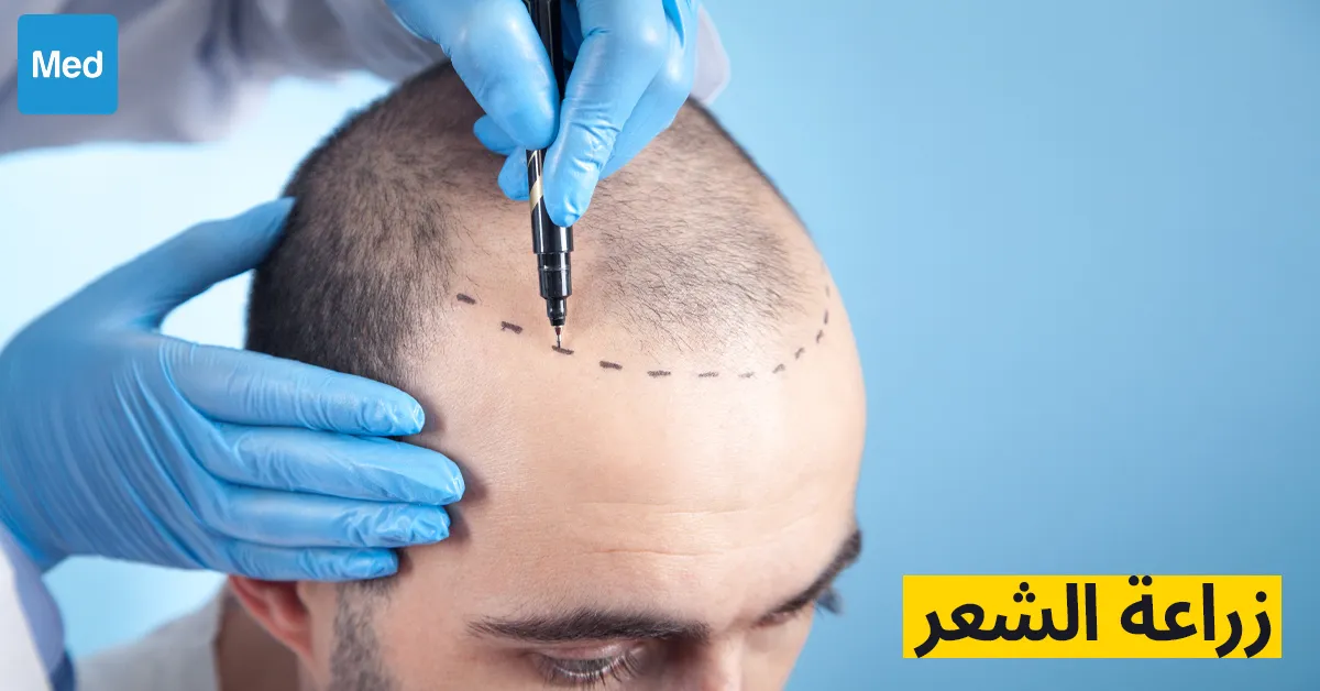 زراعة الشعر